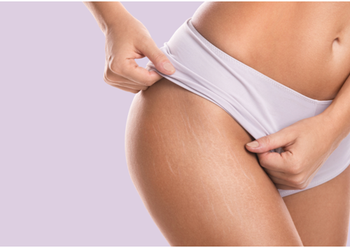 How to get rid of stretch marks on bum?