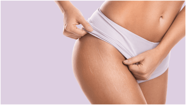How to get rid of stretch marks on bum?